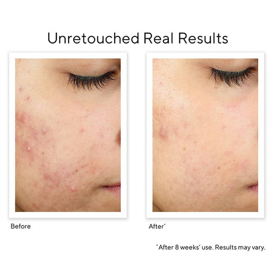Blemish Control InvisiScar Resurfacing Treatment