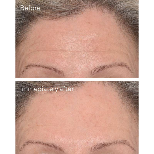 Resurgence Targeted Wrinkle Corrector