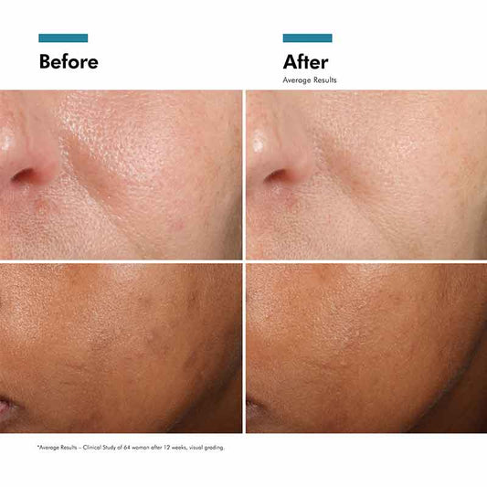 Phloretin CF Serum For Discolouration 30ml