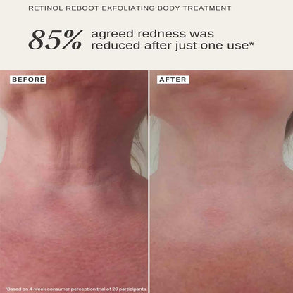 Retinol Reboot Exfoliating Body Treatment 1% Encapsulated Retinol by Alpha-H