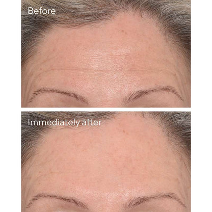Resurgence Targeted Wrinkle Corrector