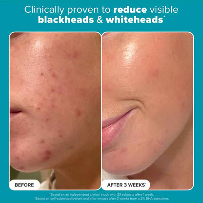 Skin Perfecting 2% BHA Exfoliating Toner + Boost 10% Azelaic Acid