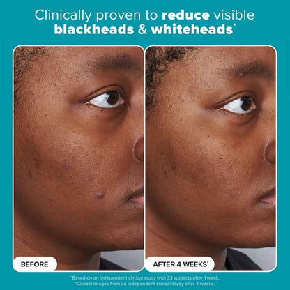 Skin Perfecting 2% BHA Exfoliating Toner + Boost 10% Azelaic Acid