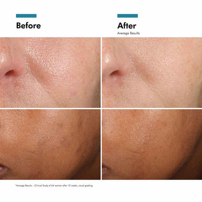 Phloretin CF Serum For Discolouration 30ml